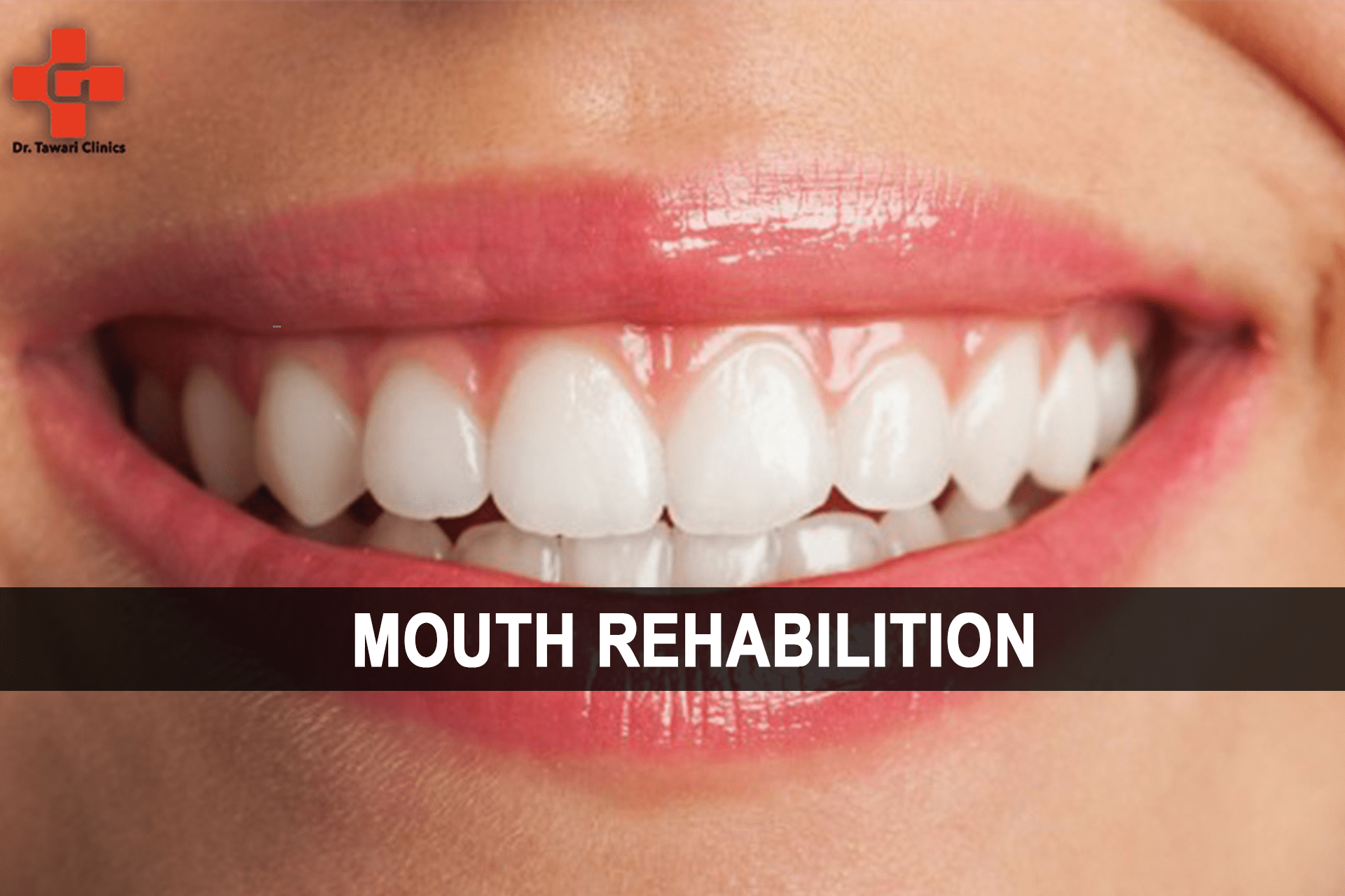 Mouth Rehabilitation-min