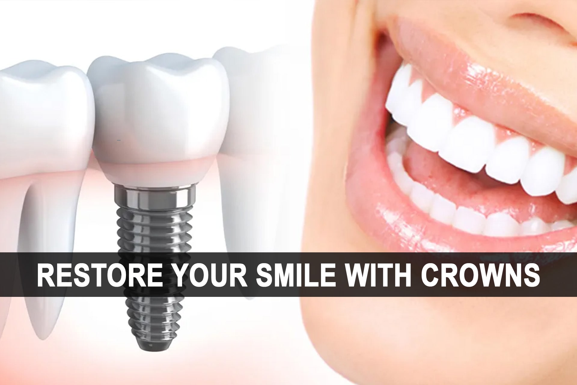Restore Your Smile With Crowns-min