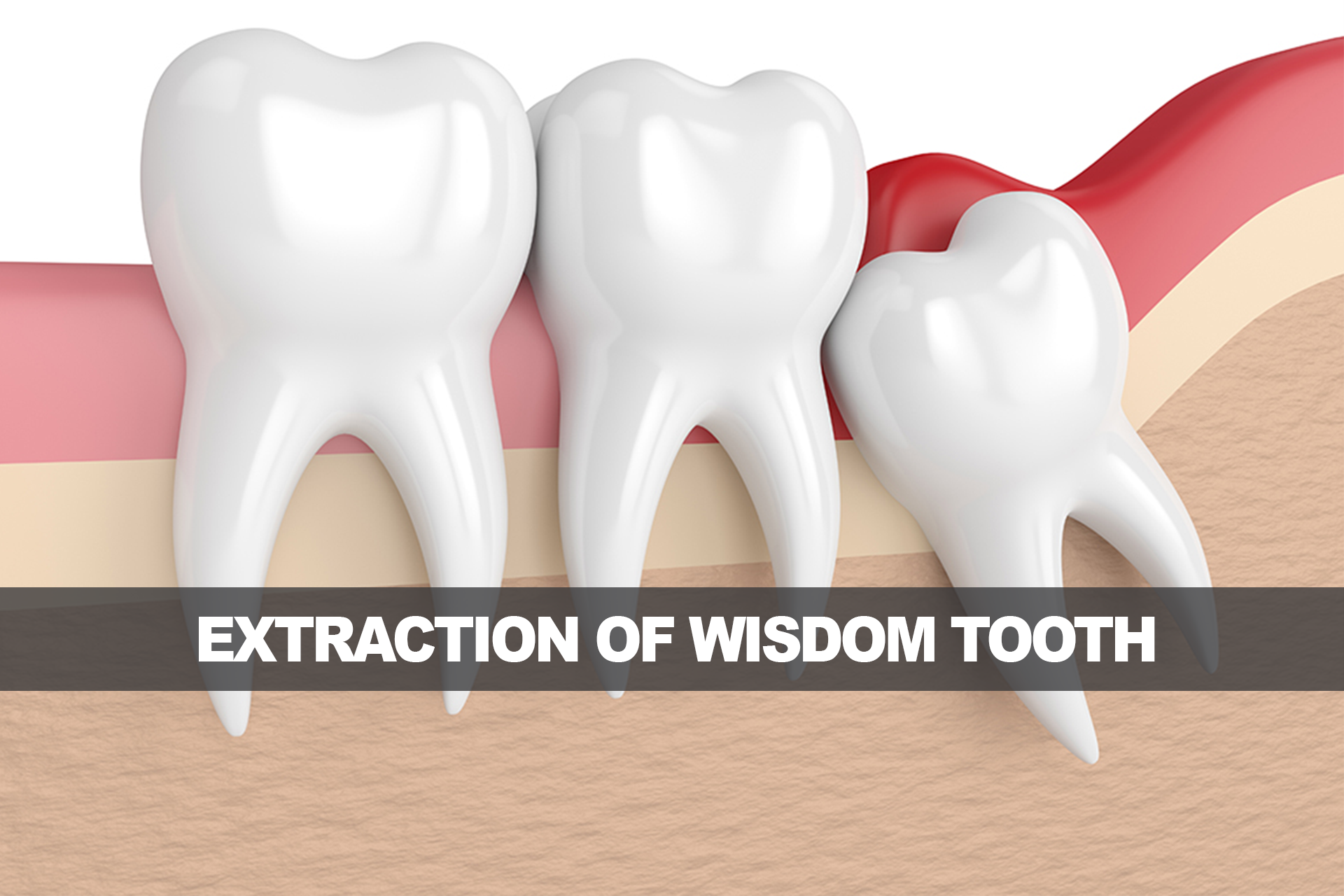 Extraction of wisdom tooth