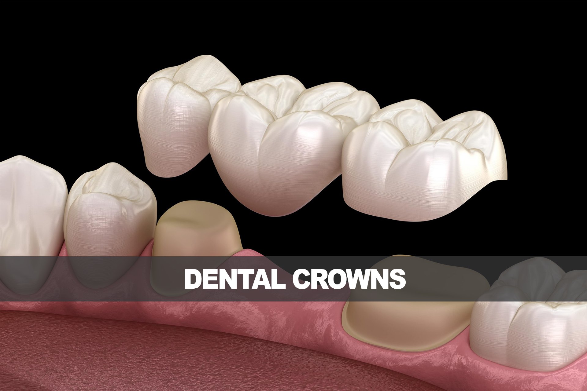 dental_crown