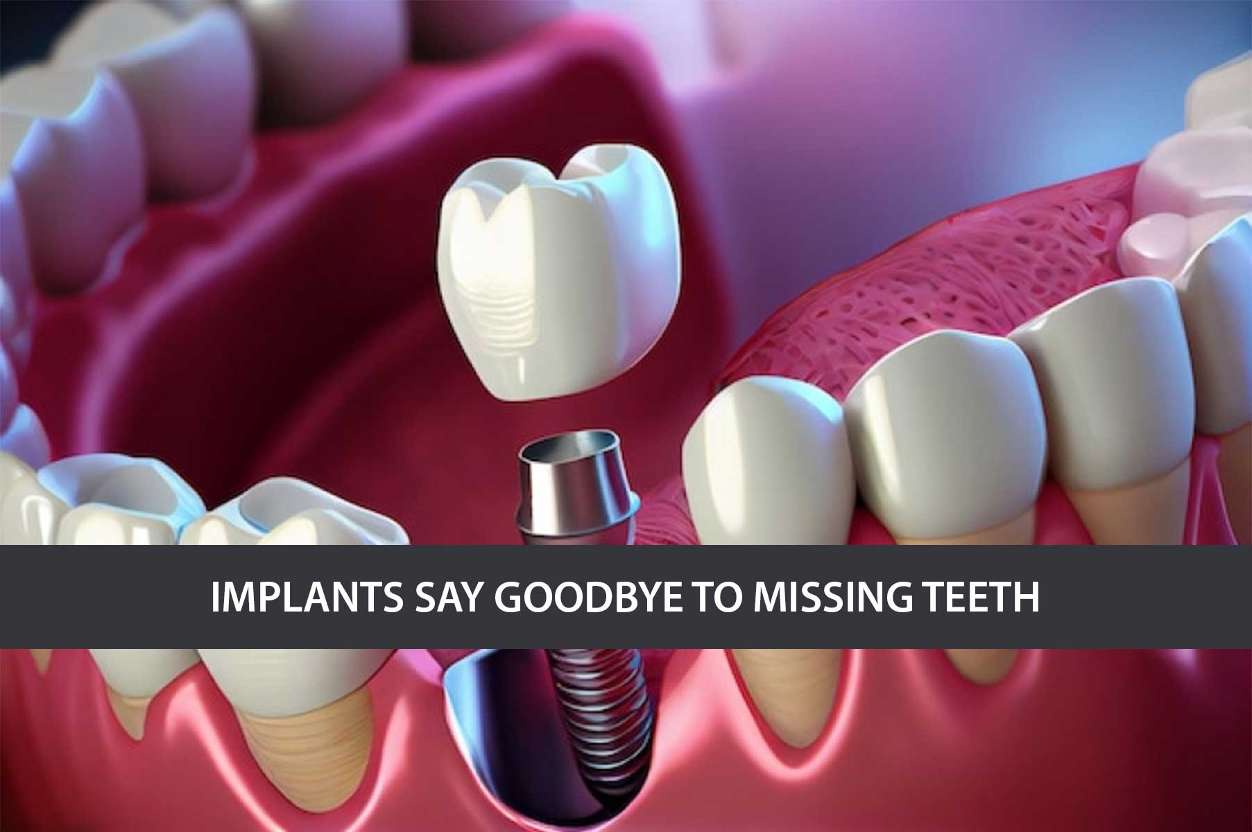 Implants-Say-Goodbye-to-Missing-Teeth