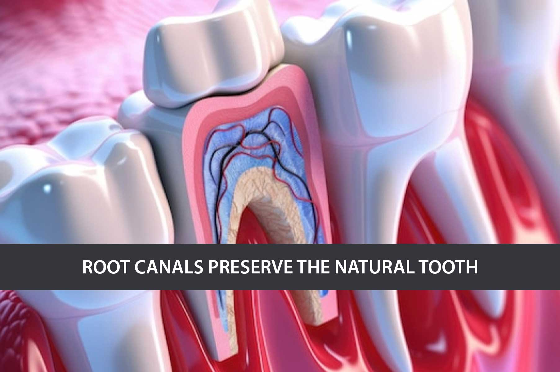 root-canals-preserve-the-natural-tooth