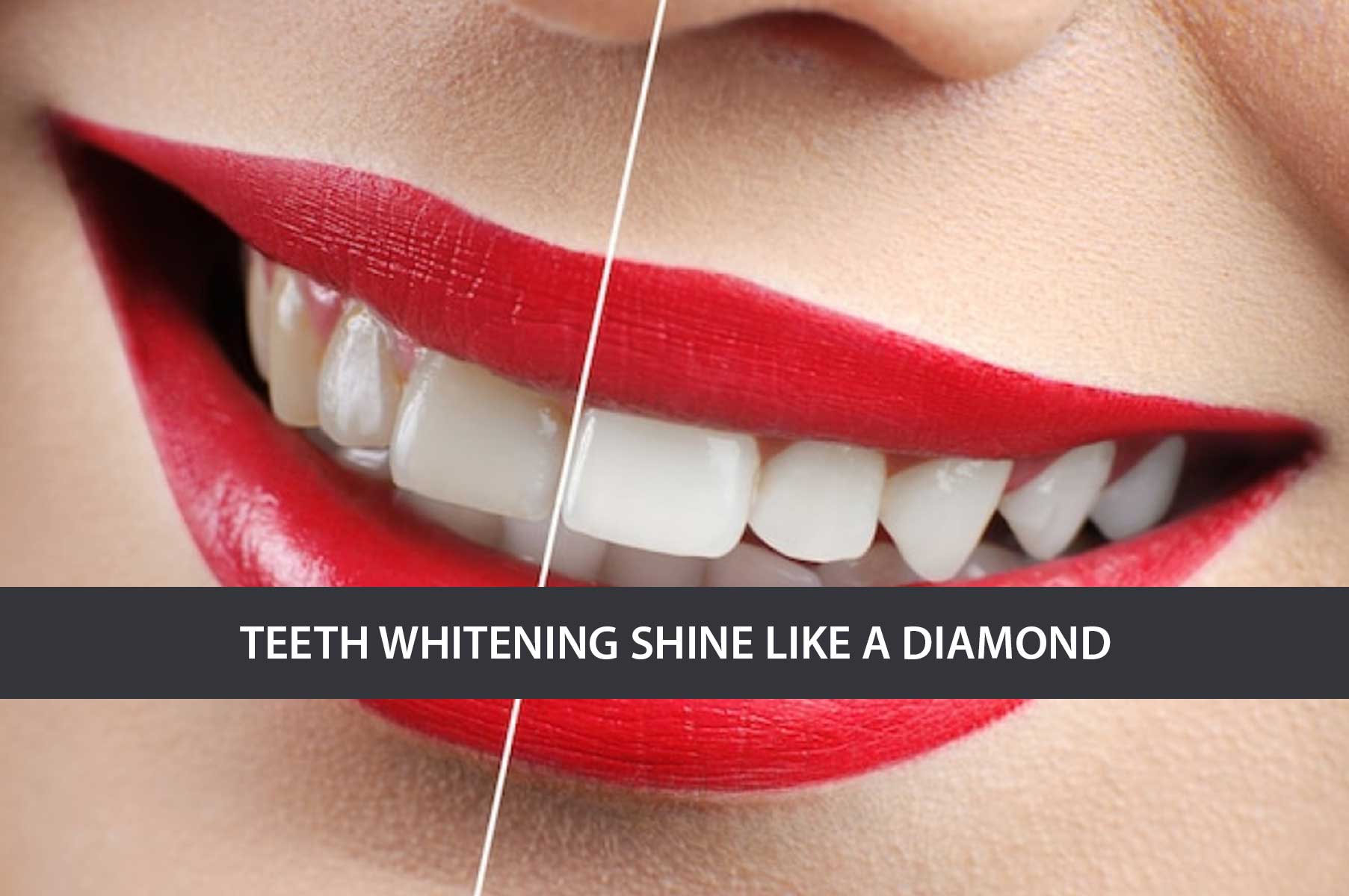 teeth-whitening-shine-like-a-diamond